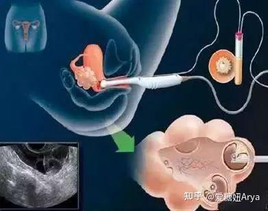 冷冻卵子之后怎么植入+冻卵后怎么移植