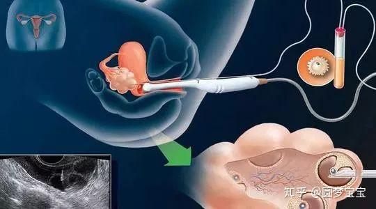 借卵试管代怀包男孩移植失败原因（鲜胚移植失败后多久可移植囊胚）